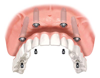 Protesis dental hibrida