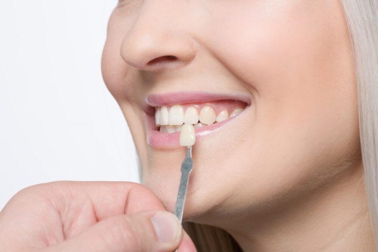 Close Up of mouth of happy woman and a shade guide